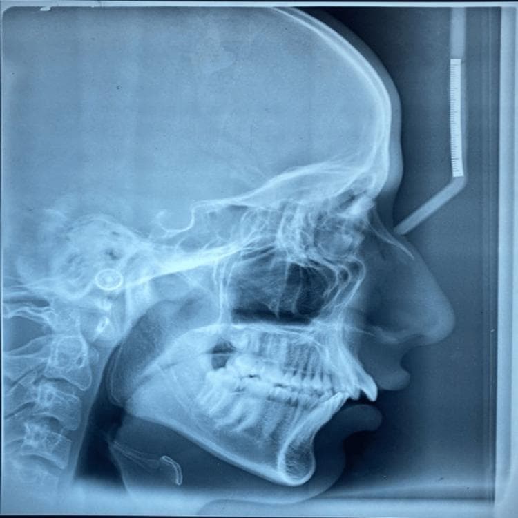 This diagnostic image is a lateral cephalometric radiograph (lateral cephalogram), a standardized extraoral X-ray used primarily in orthodontics and maxillofacial surgery. The image displays a profile view of the human skull, including the cranium, facial bones, and the cervical spine. Key anatomical structures visible include the maxilla, mandible, sella turcica, frontal sinus, and the nasal bone. The soft tissue profile of the nose, lips, and chin is discernible, allowing for the assessment of skeletal and dental relationships to the integumentary profile. Radiopaque features include the dentition within the alveolar processes and a vertical calibration ruler located anterior to the forehead, which is used for linear measurements and scale. A circular radiopaque ear rod (earpost) from the cephalostat is visible in the external auditory meatus region to ensure standardized head positioning. This modality is essential for cephalometric tracing to analyze growth patterns, dental malocclusion, and treatment planning for orthognathic surgery.