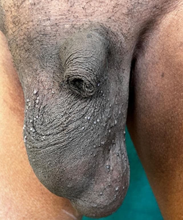 This clinical photograph shows the scrotum and base of the penis of an individual with dark skin. The primary findings are multiple, small, discrete papules scattered across the scrotal surface, consistent with Angiokeratomas of Fordyce. These lesions are approximately 1-3 mm in diameter, dome-shaped, and appear slightly lighter or more reflective than the surrounding hyperpigmented, rugose scrotal skin. The distribution is widespread but relatively uniform. The scrotal skin exhibits a typical rough, wrinkled texture (rugosity), and there is a prominent fold of redundant skin near the superior aspect of the scrotum. This image serves as a classic educational representation of benign vascular lesions of the genital skin, often presenting in older men, and helps in the differential diagnosis of common genital papules.