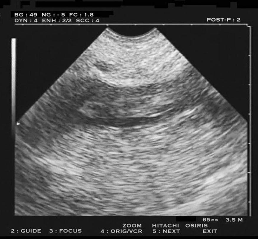 This diagnostic ultrasound image, captured in the longitudinal plane using a microconvex probe, demonstrates a deep venous thrombosis (DVT) within the external iliac vein. The image shows a prominent hypoechoic, elongated tubular structure representing the vein. Within the vessel lumen, there is a distinct, heterogeneously echogenic mass consistent with a 'floating' thrombus. The thrombus displays a mottled texture with interspersed hyperechoic and hypoechoic areas, appearing detached from the vessel walls at certain points. The surrounding tissues exhibit varying echogenicity with horizontal banding patterns. This visual is clinically significant for identifying high-risk venous thromboembolism, where the substantial volume and lack of complete adherence to the vessel wall suggest a high risk of dislodgement and subsequent pulmonary embolism. The imaging is part of a point-of-care ultrasound (POCUS) protocol used for pre-transportation screening in critical care and emergency medicine.