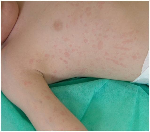 This clinical photograph displays a widespread cutaneous manifestation on a pediatric patient's torso and upper extremity. The presentation is characterized as a salmon-macular rash, featuring numerous discrete and confluent salmon-pink erythematous lesions. The lesions are primarily macular, appearing flat and flush with the skin surface, with irregular margins and varying sizes. Some areas exhibit linear or streaky patterns among the scattered spots. This specific visual finding is a hallmark clinical feature of systemic juvenile idiopathic arthritis (sJIA), often presenting during fever spikes. The image demonstrates the classic morphology and distinctive hue essential for differentiating sJIA from other pediatric exanthems or inflammatory conditions. The distribution includes the chest, abdomen, and the inner aspect of the arm, highlighting the diffuse and migratory nature of the rash in rheumatological contexts.