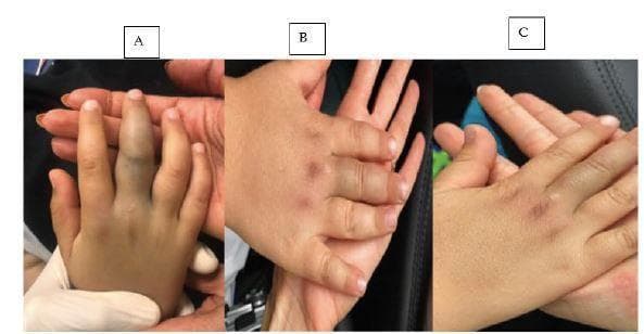 This sequence of three clinical photographs (A, B, and C) illustrates the clinical progression and resolution of localized soft tissue envenomation on a pediatric patient's right hand following a Montivipera bornmuelleri snakebite. Image A shows the acute phase: the right middle finger is severely edematous, primarily over the middle phalanx, with deep bluish-purple ecchymosis and tense swelling compared to adjacent unaffected digits. Image B demonstrates the follow-up 24 hours after antivenom administration, showing a marked reduction in digital girth and lightening of the ecchymotic discoloration. Image C shows the status four days post-injury, where the swelling has almost entirely resolved, and the ecchymosis has faded to faint, yellowish-brown residual bruising. The series serves as an educational example of the local cytotoxic and hemotoxic effects of certain viperid venoms and the efficacy of timely antivenom treatment in managing pediatric envenomation cases. Key clinical signs include edema, ecchymosis, and eventual resolution of localized tissue trauma.