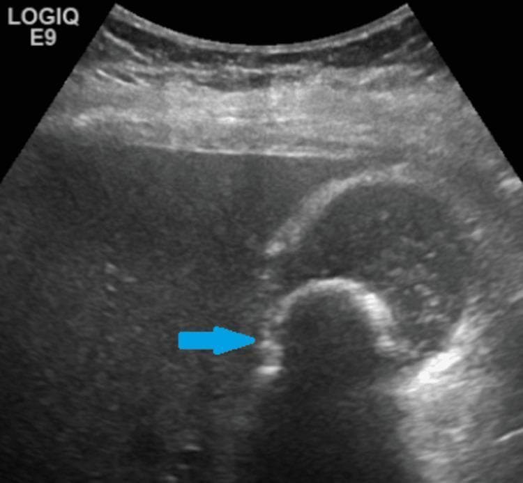 This abdominal ultrasound image displays a diagnostic view of the gallbladder containing a prominent 2.7-cm gallstone (cholelithiasis), indicated by a blue arrow. The gallstone appears as a curvilinear, highly hyperechoic structure within the gallbladder lumen. Characteristically, there is a clear, well-defined area of posterior acoustic shadowing distal to the calculus, resulting from the attenuation of ultrasound waves by the dense calcified object. The gallbladder itself appears as a sac-like structure with primarily anechoic (fluid-filled) contents, although scattered low-level internal echoes are present, suggesting the presence of biliary sludge. The surrounding liver parenchyma shows a uniform echotexture. This image is a classic representation used in radiology and gastroenterology for teaching the sonographic diagnosis of uncomplicated cholelithiasis, emphasizing the 'bright' appearance of stones and the diagnostic importance of acoustic shadowing.