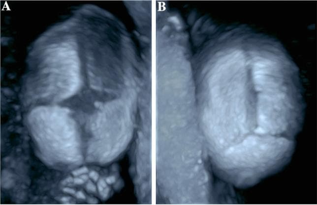This diagnostic image utilizes 3D ultrasonic skeletal imaging to demonstrate the normal anatomy of a fetal skull in utero. The visualization focuses on the cranial sutures and fontanelles, which appear as hypoechoic linear gaps between the ossified cranial bones. Panel A provides a superior-frontal view, highlighting the anterior fontanelle, a large diamond-shaped gap where the frontal (metopic), sagittal, and bilateral coronal sutures converge. Panel B displays a posterior view of the skull, showing the posterior fontanelle, a smaller triangular space where the sagittal suture meets the bilateral lambdoid sutures. The imaging modality clearly delineates the margins of the frontal, parietal, and occipital bones. This clinical visualization is essential for prenatal screening of syndromic and non-syndromic craniosynostosis, allowing for the assessment of suture patency and the identification of premature fusion or abnormal skull morphology.