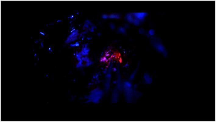 An intraoperative clinical photograph showing a neurosurgical field under blue light (400 nm) during a 5-aminolevulinic acid (5-ALA)-guided resection of a glioblastoma. The image demonstrates protoporphyrin IX (PpIX) fluorescence, a key diagnostic and surgical aid for identifying malignant tissue. In the center of the surgical cavity, the tumor bulk exhibits intense, well-defined red fluorescence. Surrounding this core, the tumor margins display a more diffuse, vague pink fluorescence, indicating transitional areas of tumor infiltration. The background healthy brain tissue appears predominantly dark or blue due to the absence of significant PpIX accumulation, providing a high-contrast visual guide for maximal safe resection. This image illustrates the clinical application of fluorescence-guided surgery in neuro-oncology for the intraoperative differentiation between high-grade glioma tissue and normal brain parenchyma.