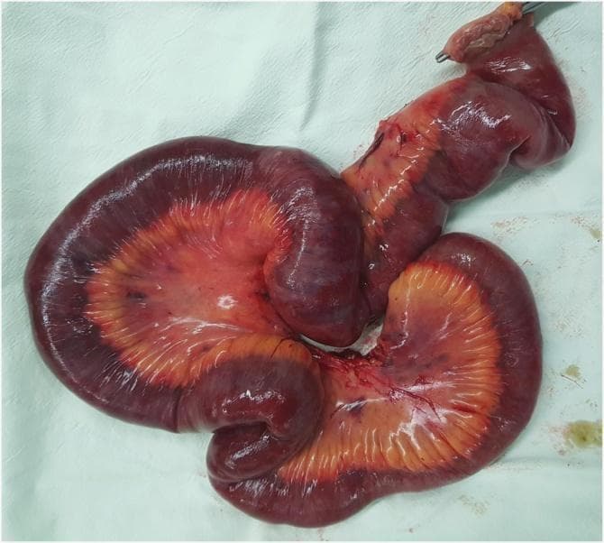 This clinical photograph shows a gross pathological specimen of a resected segment of the human small bowel (jejunum). The image illustrates extensive transmural intestinal and mesenteric infarction. The bowel loops exhibit profound discoloration, transitioning from a congested, dusky red to dark purple and black, indicating advanced ischemic necrosis. The adjacent mesentery is similarly affected, showing marked hemorrhage, congestion, and a loss of its normal translucency, appearing thickened and orange-red with dark hemorrhagic streaks. The bowel wall appears edematous and lacks the shiny serosal sheen of healthy tissue, appearing instead dull and distorted. A surgical clamp is visible at one resection margin. This specimen serves as a clear educational example of acute mesenteric ischemia progressing to gangrenous infarction, necessitating emergent surgical intervention and bowel resection.