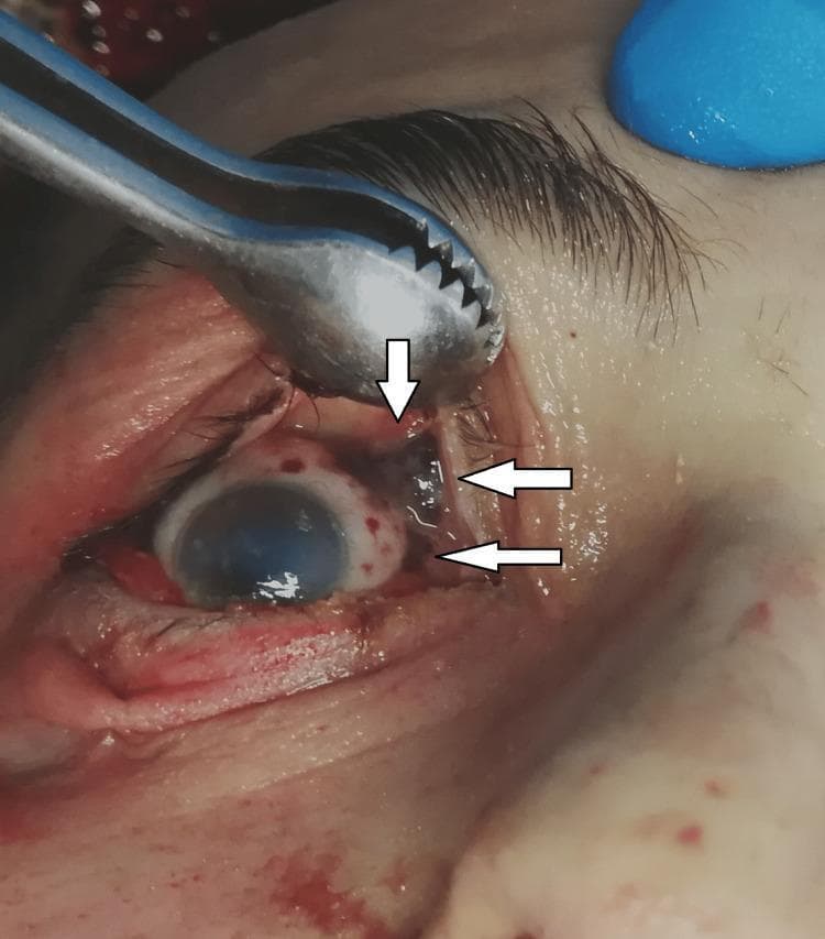 This clinical photograph from a forensic postmortem examination depicts the right eye of a deceased individual, illustrating significant subconjunctival findings. The eyelids are mechanically retracted using a serrated surgical instrument to expose the bulbar conjunctiva and sclera. Scattered throughout the conjunctiva are multiple petechial and dot-like dark reddish hemorrhages, some of which exhibit a merging or confluent pattern (tardieu spots). The cornea displays postmortem clouding with a characteristic bluish, opaque hue, and the surrounding scleral tissue appears mildly hyperemic or bloodshot. White arrows are used in the image to point specifically to the clusters of conjunctival hemorrhages. This visual is a classic forensic indicator often associated with asphyxiation or increased cephalic venous pressure, serving as critical evidence in pathology and legal medicine for determining the mechanism of death.