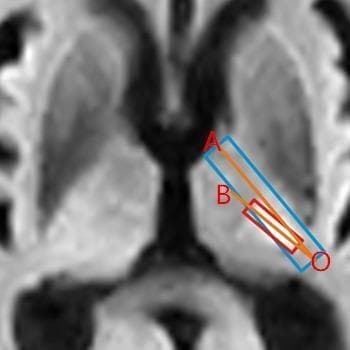 This diagnostic image is an axial cross-section of a human brain, likely from a computerized tomography (CT) or magnetic resonance imaging (MRI) scan, focusing on the basal ganglia and internal capsule region. The image illustrates a quantitative method for assessing the orientation of an intracranial infarction relative to the posterior limb of the internal capsule (PLIC). A blue rectangle outlines the anatomical boundaries of the PLIC. A smaller, diagonally oriented red rectangle highlights a localized infarction lesion within this region. The diagram uses orange lines to define specific axes: line segment 'AO' represents the perpendicular bisector of the short axis of the PLIC, while line segment 'BO' represents the long axis of the infarction lesion. The vertex 'O' serves as the common point of intersection, defining angle '∠AOB'. This measurement provides a standardized way to determine the lesion's spatial relationship with surrounding structures like the thalamus and putamen. This content is intended for advanced medical education in neurology or radiology to illustrate clinical research methodology for correlating stroke localization with motor deficits.