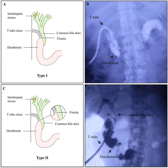 A multi-panel figure illustrating two types of T-tube sinus tract duodenal fistulas. Panels A and C are anatomical diagrams showing the relationship between intrahepatic stones, the common bile duct, the T-tube sinus tract, and the duodenum. Panels B and D are fluoroscopic images (T-tube cholangiography) demonstrating these complications. In Type I (A and B), the diagram shows the T-tube unintentionally inserted directly into the duodenum through a fistula; the corresponding cholangiogram in Panel B shows contrast material filling the duodenum with an absence of opacification in the biliary tree, indicating complete diversion or distal blockage of the sinus tract. In Type II (C and D), the diagram depicts a fistula allowing communication between the T-tube sinus, duodenum, and common bile duct; the cholangiogram in Panel D shows initial contrast filling of the duodenal loop followed by retrograde opacification of the common bile duct and intrahepatic ducts. The image serves as an educational reference for hepatobiliary complications following procedures for intrahepatic stone extraction, specifically the diagnostic presentation of iatrogenic fistulous tracts on imaging.