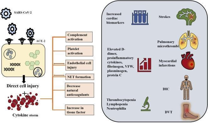 This medical infographic illustrates the pathophysiology of COVID-19-induced hyperinflammatory and hypercoagulable states. The diagram begins with SARS-CoV-2 virions binding to ACE-2 receptors on a host cell, leading to endocytosis and viral replication. This process results in direct cell injury and a subsequent cytokine storm, characterized by a proliferation of pro-inflammatory mediators. These events trigger a signaling cascade including complement and platelet activation, endothelial cell injury, Neutrophil Extracellular Trap (NET) formation, increased tissue factor, and decreased natural anticoagulants. The right side of the infographic correlates these mechanisms with laboratory findings and clinical manifestations. Laboratory indicators include increased cardiac biomarkers, elevated D-dimer, fibrinogen, and VWF (represented by bar graphs and test tubes), and hematological abnormalities like thrombocytopenia and lymphopenia (represented by a microscope). Clinical outcomes are depicted through anatomical icons showing strokes, pulmonary microthrombi, myocardial infarctions, disseminated intravascular coagulation (DIC), and deep vein thrombosis (DVT).