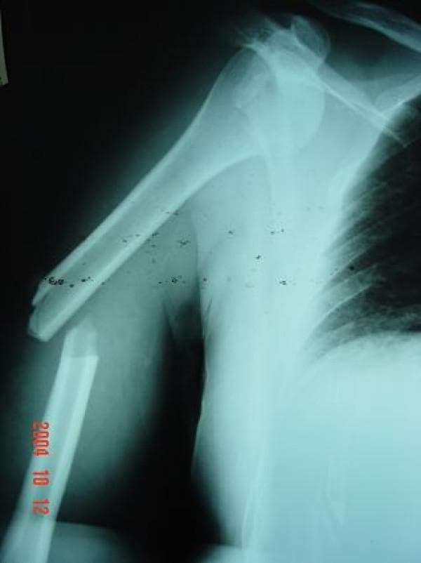 Anteroposterior (AP) radiograph of the right shoulder and humerus demonstrating a concomitant proximal injury and midshaft fracture. The glenohumeral joint shows an anterior dislocation, characterized by the displacement of the humeral head inferior and anterior to the glenoid fossa (subcoracoid position). Distal to the shoulder joint, there is a complete, transverse fracture through the middle third of the humeral shaft. The fracture shows significant lateral displacement and overriding (shortening) of the distal fragment relative to the proximal fragment. The clavicle and visible thoracic cage appear intact. This combination of injuries is clinically significant as the humeral shaft fracture complicates the standard leverage maneuvers used for closed reduction of the shoulder dislocation. Educational focus includes orthopedic trauma assessment, recognition of multi-level upper extremity injuries, and surgical planning for fracture-dislocation management.