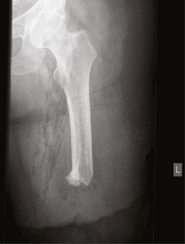 This diagnostic image is a plain radiograph (X-ray) of the left upper leg following an above-knee amputation and subsequent surgical revision. The roentgenogram displays a significantly shortened femur. The proximal anatomy, including the femoral head, neck, and greater trochanter, remains intact within the acetabulum. The distal femoral stump is truncated and demonstrates an irregular, blunted morphology consistent with surgical bone resection and curettage. Notable findings include a decrease in bone density at the distal aspect of the stump, indicating a more porous or osteopenic appearance compared to the mid-shaft. The surrounding soft tissue shows mottled radiographic densities and faint silhouettes, suggestive of post-surgical changes, scarring, and edema within the residual limb. This image is clinically relevant for evaluating stump morphology, bone remodeling, and the presence of heterotopic ossification or surgical complications like gossypiboma-related changes in orthopedics and rehabilitation medicine. A radio-opaque marker 'L' indicates the left orientation.