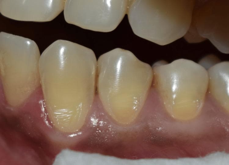 This intraoral clinical photograph provides a close-up view of the mandibular teeth, specifically highlighting a non-carious cervical lesion (NCCL) on tooth 34. The image illustrates the typical morphology of an NCCL, characterized by a smooth, wedge-shaped or saucer-shaped loss of hard tissue at the cementoenamel junction (CEJ). The affected tooth surface exhibits a glossy, yellowish-white enamel texture with distinct horizontal and vertical striations within the defect. The surrounding gingiva appears healthy, pink, and scalloped, with a slight apical recession following the contour of the lesion. To ensure a clear operative field for clinical study, soft tissue management is achieved through retraction using cotton rolls and a saliva ejector, which are visible at the inferior border of the frame. This image is an educational example for restorative dentistry and periodontology, demonstrating the clinical presentation of abfraction, erosion, or abrasion before the application of topical anesthesia or restorative composite materials.