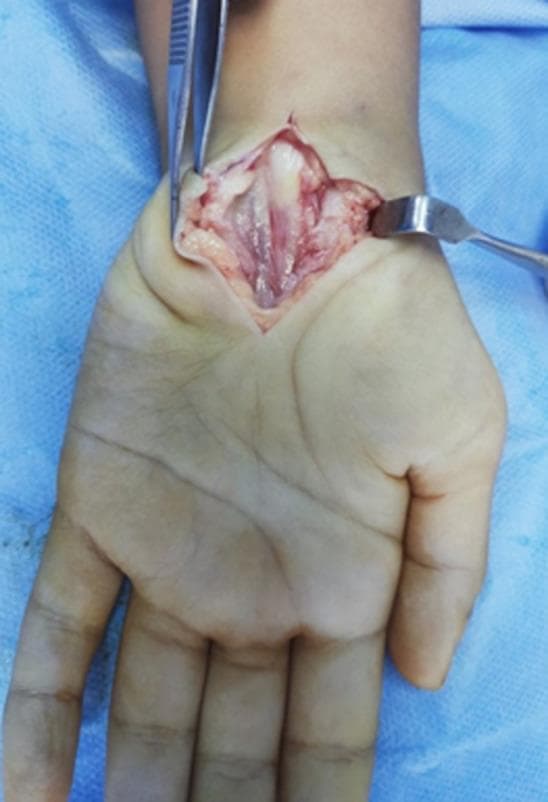An intra-operative clinical photograph showing a neurolysis of the median nerve at the right wrist. The image reveals a longitudinal incision through the skin and subcutaneous tissue, held open by a metal retractor and forceps to provide a clear view of the carpal tunnel structures. The median nerve is visible as a central, cord-like structure with a glistening surface and longitudinal striations. A notable pathological finding is the constricted, shrunken appearance of the nerve distal to the transverse carpal ligament, exhibiting a distinct bluish-pale discoloration compared to the surrounding pinkish connective tissue. This finding is consistent with chronic compression and hourglass deformity often seen in severe carpal tunnel syndrome, specifically associated here with Mucopolysaccharidosis (MPS) Type 1. The anatomical region focuses on the volar aspect of the wrist and palm, demonstrating the surgical exposure and pathological nerve morphology for educational purposes in orthopedics, hand surgery, and pediatric metabolic diseases.