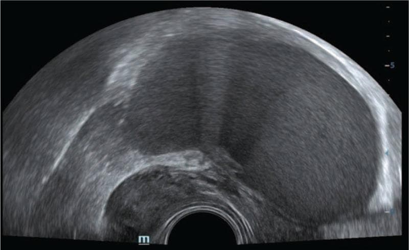 This diagnostic image is a transrectal sonogram (TRS) of the pelvic region in a patient presenting with symptoms of dysmenorrhea and chronic pelvic pain. The ultrasound demonstrates a significant nodular, solid, hypo-echoic lesion located within the ovarian fossa. The lesion is characterized by its dark, heterogeneous internal texture and irregular borders, which contrast with the adjacent, more echogenic pelvic structures. A hyperechoic curved line at the bottom of the frame indicates the rectal wall interface with the probe. This finding is highly suggestive of Deep Infiltrating Endometriosis (DIE) involving the ovarian fossa. The image serves as a clinical example of how high-frequency sonography can be utilized to identify extra-intestinal endometriotic implants by assessing echogenicity, tissue morphology, and spatial relationships within the pelvic compartments.