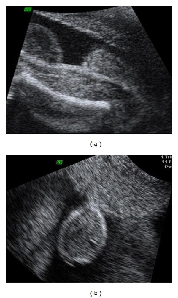 Diagnostic ultrasound images (a and b) in grayscale, demonstrating fetal genital anatomy at the 27th week of pregnancy via an abdominal approach. The images focus on the perineal region of a male fetus to evaluate suspected penoscrotal hypospadias. In image (a), the scrotum is visible as a distinct hyperechoic, rounded structure, but the phallus (penis) is conspicuously absent or poorly visualized in its expected anatomical position. In image (b), an alternative cross-sectional view emphasizes the scrotal sac, which appears somewhat bifid or flattened, again without a clearly identifiable protruding penis. This lack of visualization of the penis in the presence of a scrotum on 2D ultrasound is a key diagnostic indicator for severe hypospadias or ambiguous genitalia. These images serve as a clinical example of the limitations of 2D ultrasound in characterizing complex urogenital malformations compared to 3D rendering, emphasizing the anatomical markers for male fetal sex determination and the detection of congenital penile abnormalities.