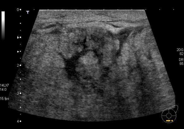 This diagnostic ultrasound image demonstrates the classic sonographic features of acute mastitis in a lactating breast. The image shows prominent skin thickening and increased hyperechogenicity of the subcutaneous tissues. The underlying breast parenchyma exhibits a markedly echogenic and heterogeneous appearance, resulting in a loss of the normal ultrasonic distinction between glandular and adipose tissues. Specifically, dilated, non-compressible milk ducts are visible, appearing as hypoechoic tubular structures amidst the dense stroma. Furthermore, visible skin lymphatics and interstitial fluid signify active inflammation and edema. These features—parenchymal echogenicity, ductal distension, and cutaneous changes—are key educational indicators used to differentiate inflammatory processes from localized abscesses or normal lactational changes in a clinical setting.