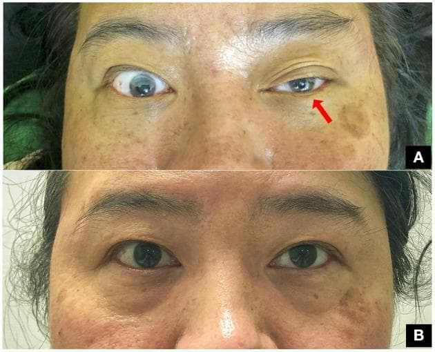 This clinical comparison photograph shows a 47-year-old woman presenting with classic oculofacial features of Horner’s syndrome following a clavicle fracture. Image A demonstrates the acute presentation of the oculosympathetic defect in the left eye, characterized by significant blepharoptosis (drooping of the upper eyelid) and ipsilateral miosis (constriction of the pupil) compared to the normal right eye. A red arrow points to the affected left eye to emphasize these findings. Image B shows the same patient at a three-month follow-up after surgical fixation of the fracture. It illustrates complete resolution of the syndrome, with symmetric eyelid positions and equal pupillary diameters (isocoria) in both eyes. This visual progression highlights the classic clinical triad (ptosis and miosis, with anhidrosis typically associated) and the potential for recovery following the management of the underlying traumatic compression of the preganglionic sympathetic pathway. The image is a valuable educational resource for neurology, ophthalmology, and trauma surgery.