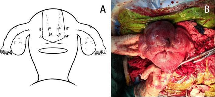 This composite educational material demonstrates the application of modified B-Lynch compression sutures used in the management of postpartum hemorrhage (PPH) due to uterine atony. Figure A is an anatomical diagram of the uterus, ovaries, and fallopian tubes, showing the puncture points (A, B, C, D) and suture pathways designed to compress the uterine corpus. Figure B is an intraoperative clinical photograph showing an exteriorized, atonic uterus during a surgical procedure. The uterus exhibits a reddish-purple, glossy appearance with visible vertical suture loops compressing the fundus and corpus. Surgical instruments, including clamps and suture material, are visible in the operative field alongside blood-stained surgical drapes. The visual illustrates a critical life-saving obstetric intervention, focusing on the mechanical compression of the uterus to achieve hemostasis when conservative measures fail. This content is intended for advanced medical education in obstetrics and gynecology, specifically for surgical training in maternal emergency procedures.
