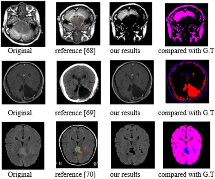 This medical comparison chart displays three rows of diagnostic brain imaging—specifically axial CT and MRI scans—demonstrating tumor segmentation performance. Each row follows a standard sequence: the 'Original' clinical image, a 'Reference' image with expert-annotated outlines (red/green), the 'Our Results' image showing the model's automated segmentation, and a 'Compared with G.T.' image visualizing spatial accuracy. Row 1 features a posterior fossa tumor; row 2 shows a large, hypodense intracranial mass with significant mass effect on CT; row 3 depicts a diffuse infiltrating glioma. The comparison column utilizes a color-coded overlap scheme where magenta indicates successful overlap between the model and the ground truth (G.T.), while distinct blue or red areas highlight regions of over-segmentation or under-segmentation. This visual material is used in neuro-oncology and radiology to evaluate the efficacy of computer-aided diagnostic algorithms in identifying and delineating brain tumors compared to established clinical reference standards.