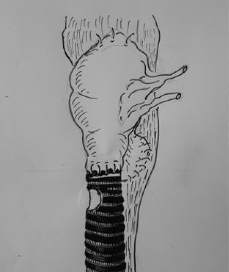 This medical illustration depicts a surgical reconstruction of the upper airway and digestive tract following a laryngectomy. The diagram shows a tracheo-pharyngeal shunt utilizing a jejunal interposition to bridge the defect between the respiratory and pharyngeal systems. Centrally, a vascularized segment of the jejunum is shown as an inflated, pouch-like structure acting as a neolarynx or air chamber. Superiorly, the jejunal segment is anastomosed to the pharynx (intestino-pharyngeal anastomosis), which serves as a neoglottis. Inferiorly, the distal end of the jejunal loop is sutured to the superior aspect of the transected trachea, identified by its characteristic horizontal cartilaginous rings. Two visible vascular pedicles extend laterally from the jejunal segment, representing the mesenteric vessels required for graft revascularization. The surrounding pharyngeal tissues are shown with vertical striations, indicating the closure of the pharyngeal defect. This technique is designed to facilitate both the closure of complex anatomical gaps and the restoration of voice function by using respiratory air redirected through the intestinal shunt.