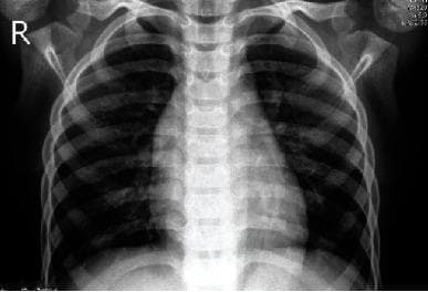 Anteroposterior (AP) chest X-ray of a patient demonstrating classic radiographic signs of pneumonia. The diagnostic image reveals significant bilateral increased pulmonary opacity, particularly prominent in the lower lung zones. These findings are consistent with consolidation or alveolar infiltrates, which obscure the normal branching pulmonary vascular markings. The cardiac silhouette and the diaphragmatic borders appear blurred and poorly defined—an example of the silhouette sign—suggesting the presence of adjacent lung consolidation or pleural fluid accumulation. The bony structures of the rib cage and clavicles are visible, with the patient's right side clearly marked with an 'R' indicator. The central mediastinal shadow and vertebral column are midline, providing anatomical orientation. This clinical imaging is used for medical education to teach the visual identification of infectious lung processes and their impact on normal anatomical silhouettes in diagnostic radiology.