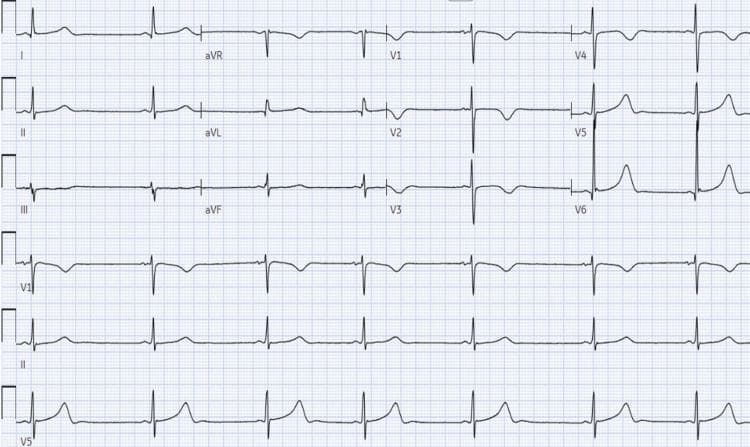 A 12-lead electrocardiogram (ECG) demonstrating marked sinus bradycardia and significant QT interval prolongation. The heart rate is notably slow, estimated between 30-35 beats per minute based on the wide spacing between QRS complexes. Each QRS complex is preceded by a P wave with a consistent PR interval, confirming a sinus rhythm. The QRS complexes exhibit normal morphology and narrow width, indicating preserved ventricular conduction. The most prominent diagnostic feature is the prolonged QT interval, which is visible across all leads, particularly in the precordial leads V4-V6. The T waves are generally upright and broad. There is no evidence of ST-segment elevation, depression, or pathological Q waves. In the context of the patient's history of Streptococcus pneumoniae meningitis and suspected intracranial hypertension, these findings may represent cardiac manifestations of neurological injury. This tracing serves as an educational example of how systemic or neurological conditions can influence cardiac repolarization and autonomic rate control.