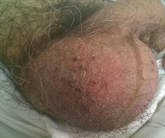 This clinical photograph shows a close-up view of human scrotal skin. The anatomical region is characterized by typical rugosity and coarse pubic hair distribution. Scattered across the surface of the scrotum are multiple, small (approximately 1-3 mm), well-circumscribed, dome-shaped papules. These lesions exhibit a dark red to purple or violaceous hue, characteristic of angiokeratomas of Fordyce. The papules appear as discrete vascular lesions and are distributed randomly across the scrotal wall. The surrounding skin shows mild erythema but is otherwise intact without signs of ulceration or active bleeding. This image is an educational example of benign vascular ectasias common in the urogenital area, often associated with increased venous pressure or aging. It serves as a classic diagnostic reference for distinguishing benign scrotal lesions from more concerning dermatological conditions.