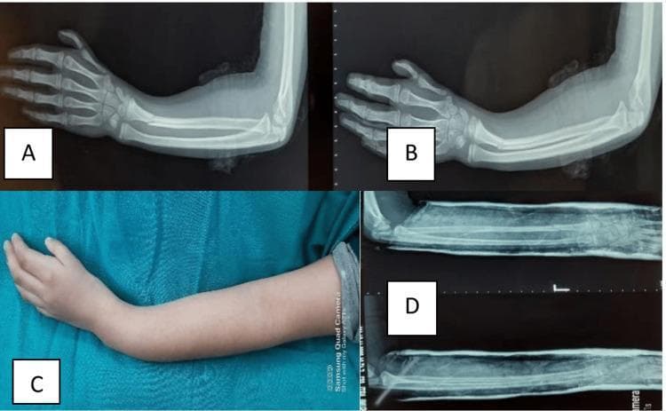 Educational panel illustrating the management of a pediatric forearm fracture, categorized into diagnostic imaging and clinical photography. Panel A displays a pre-reduction lateral X-ray of a pediatric forearm showing a greenstick fracture of the distal radius with characteristic cortical bowing and dorsal angulation; the ulna appears intact. Panel B is a post-reduction lateral X-ray demonstrating corrected alignment of the radial shaft following closed manipulation. Panel C is a clinical photograph of the patient's forearm, showcasing the visible physical deformity often described as a 'dinner fork' or volar-angulated appearance at the distal forearm and wrist, with intact skin and no obvious bruising. Panel D provides post-reduction X-rays within a cast, confirming satisfactory anatomical realignment in multiple planes. This sequence serves as an educational tool for identifying pediatric greenstick fractures, visualizing clinical deformities, and assessing the success of orthopedic closed reduction procedures in the emergency or orthopedic setting.