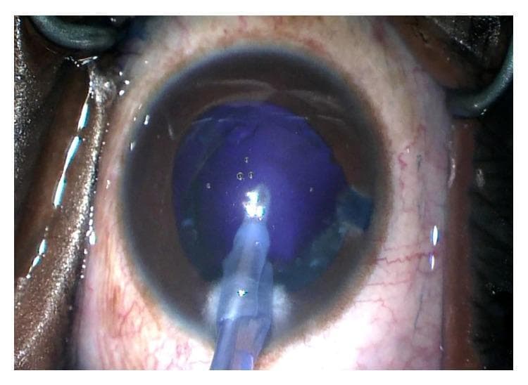 This clinical photograph captures a surgical view of the anterior segment during cataract surgery, specifically after the removal of the lens cortex. The image shows the eye with the cornea and sclera visible, and the surgical field is maintained by a speculum. Within the dilated pupil, the posterior capsule is prominently visible and exhibits a distinct deep blue hue, likely due to unintended Trypan Blue staining. The typical red reflex is notably absent. An irrigation and aspiration (I/A) handpiece is positioned centrally within the anterior chamber, used to clear cortical material. Tiny air bubbles are present on the surface of the capsule or within the viscoelastic material. The image illustrates a specific intraoperative finding where the dye, intended only for the anterior capsule, has reached the posterior capsule, facilitating its visualization during the final stages of phacoemulsification.