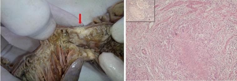 A composite image demonstrating clinical and histopathological findings of abdominal tuberculosis. The left panel is a clinical photograph of a resected small bowel segment during a laparotomy. A prominent red arrow indicates a focal stricture with significant luminal narrowing and mucosal thickening, consistent with granulomatous ileitis. The right panel displays a histopathological section (H&E stain, 100x magnification) showing an epithelioid cell granuloma. Key features include central caseous necrosis and a Langhans giant cell located adjacent to the muscularis mucosae. An inset in the upper left corner of the histopathology panel shows a similar granulomatous reaction within a dissected mesenteric lymph node. These findings collectively illustrate the classic morphological and microscopic features of intestinal tuberculosis, highlighting the progression from macroscopic obstruction to microscopic necrotizing granulomatous inflammation.