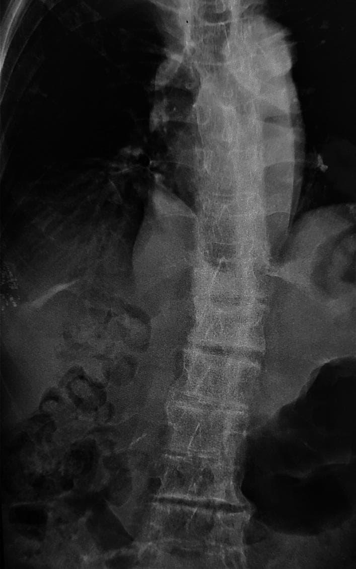 Frontal (anteroposterior) X-ray of the thoracolumbar spine demonstrating classic features of ankylosing spondylitis. The most prominent finding is the 'bamboo spine' appearance, characterized by diffuse, thin, vertical syndesmophytes that bridge the intervertebral disc spaces along the lateral aspects of the vertebral bodies. These osseous bridges are the result of ossification of the outer fibers of the annulus fibrosus. The vertebral bodies exhibit a 'squaring' morphology with irregular endplates and narrowed intervertebral spaces. There is evidence of diffuse bone demineralization (osteopenia), resulting in a generalized decrease in radiodensity and a more translucent appearance of the trabecular bone. The image also captures a mild scoliotic curvature and loss of the normal spinal contours. This diagnostic image illustrates the chronic progression of an inflammatory spondyloarthropathy, emphasizing the fusion of spinal segments and associated metabolic bone changes often seen in long-term clinical cases.