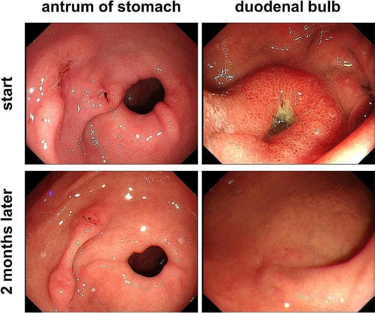 This diagnostic comparison chart displays four gastroscopic images documenting the healing progression of peptic ulcers. The images are arranged in a 2x2 grid, categorized by anatomical location (antrum of stomach and duodenal bulb) and timeline (start vs. 2 months later). The 'start' images reveal significant mucosal injury: the gastric antrum shows a deep, large ulcer with surrounding mucosal erosions, while the duodenal bulb demonstrates a prominent ulcer with central green slough and erythematous, inflamed surrounding tissue. The '2 months later' images, following treatment with a proton pump inhibitor (omeprazole), illustrate substantial healing. In the gastric antrum, the ulcer has markedly decreased in size with smoothing of the adjacent mucosa. In the duodenal bulb, the ulcer has completely resolved, replaced by a red linear scar and healthy regenerative epithelium. This visual evidence highlights the efficacy of pharmacologic intervention in treating NSAID-related (aspirin-induced) peptic ulcer disease and the capacity for mucosal recovery over a two-month period.