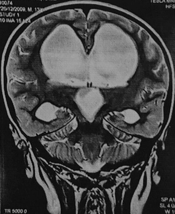 A T2-weighted coronal magnetic resonance imaging (MRI) scan of a human brain demonstrating significant obstructive hydrocephalus. The image clearly shows marked, symmetric dilation of both lateral ventricles and the third ventricle. These cerebrospinal fluid (CSF)-filled spaces exhibit characteristic high signal intensity (bright white) against the lower signal intensity (darker grey) of the surrounding brain parenchyma. The third ventricle appears widened and inferiorly displaced. The cortical mantle and white matter show signs of compression due to the massive ventricular enlargement. This diagnostic image illustrates the radiological features associated with CSF flow obstruction, such as from a third ventricular cyst or aqueductal stenosis, leading to non-communicating hydrocephalus. The visualization of the cerebellum and brainstem inferiorly provides anatomical context for the degree of supratentorial pressure.