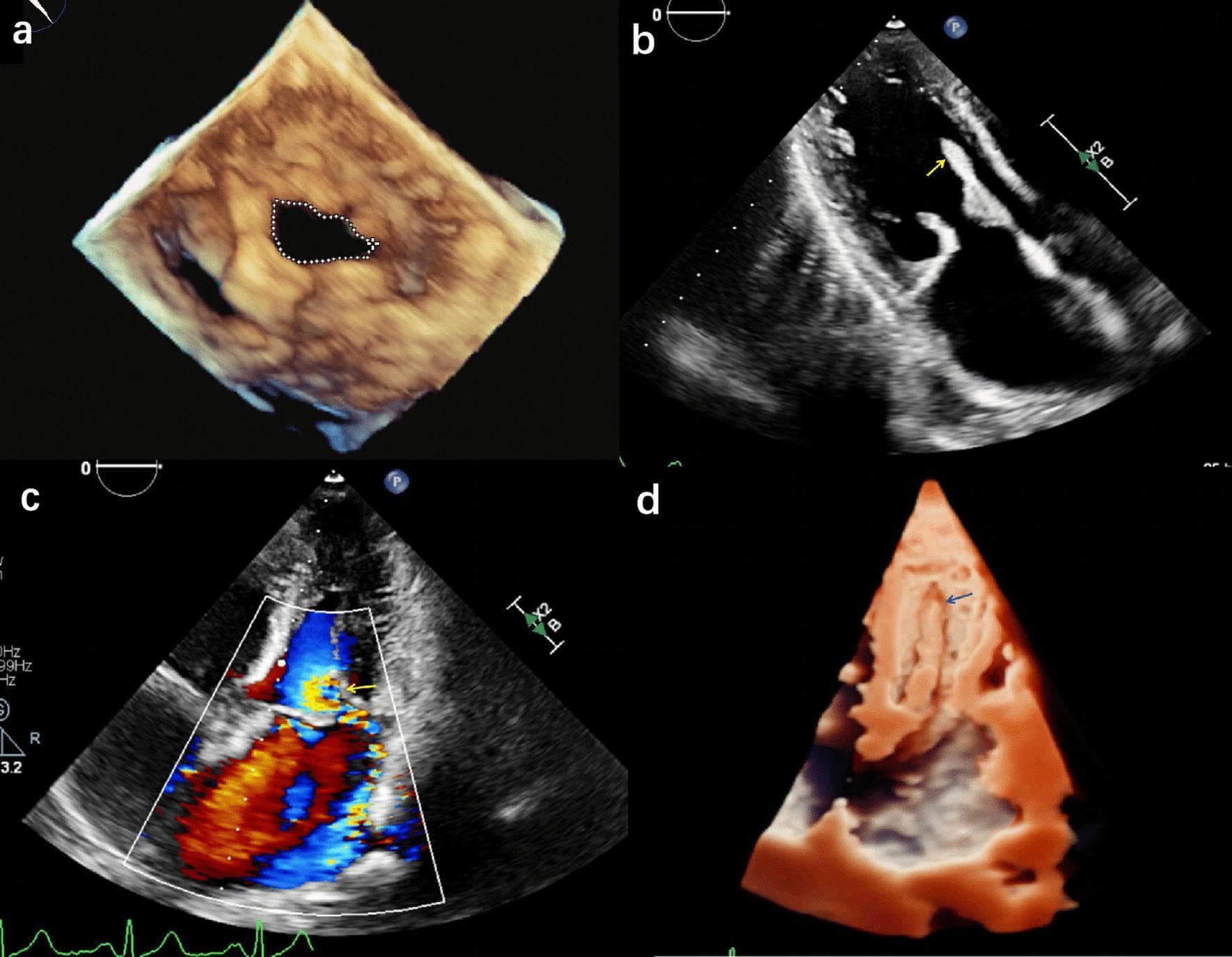 This four-panel image displays diagnostic echocardiographic findings related to mitral valve pathology and its complications. Panel (a) shows a 3D transesophageal echocardiography (TEE) volume rendering of the mitral valve in an atrial view, illustrating mitral stenosis with a thickened, restricted orifice outlined by a dotted line. Panel (b) is a 2D transthoracic echocardiogram (TTE) in an apical four-chamber view, where a yellow arrow identifies a mobile, echogenic mass in the left atrium, suggesting papillary muscle avulsion. Panel (c) utilizes Color Doppler Flow Imaging to demonstrate a large, turbulent regurgitant jet (indicated by a yellow arrow) extending from the mitral valve into the left atrium, diagnostic of severe mitral regurgitation. Panel (d) provides a 3D TTE reconstruction of the left ventricle, where blue arrows highlight the avulsed papillary muscle detached from the ventricular wall. This series illustrates the progression from rheumatic mitral stenosis to acute valvular failure due to subvalvular apparatus injury, emphasizing the role of multi-modal ultrasound in assessing valvular structural integrity and hemodynamic severity.