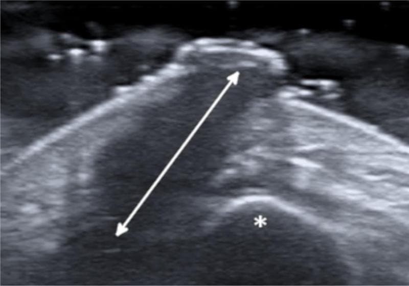 This diagnostic image is a high-frequency (18 MHz) grayscale ultrasonography of the chin and submental region. The scan demonstrates a distinct, wide hypoechoic band (indicated by a double-headed arrow) that represents an inflamed, tortuous sinus tract. This tract originates from the deeper structures and traverses vertically through the subcutaneous tissue layers toward the skin surface. The tract terminates near the mandibular bone, marked with an asterisk, showing a direct anatomical connection between the deep osseous tissue and the superficial soft tissue. The surrounding soft tissues show heterogenous echogenicity, consistent with inflammatory changes. This visual evidence is a key diagnostic feature for an odontogenic cutaneous fistula (OCF), illustrating the pathway of chronic infection from a dental origin through the mandible to a cutaneous exit point. The image is used in medical education to teach the sonographic appearance of fistulous tracts and the importance of identifying deep dental sources in persistent cutaneous nodules of the head and neck.