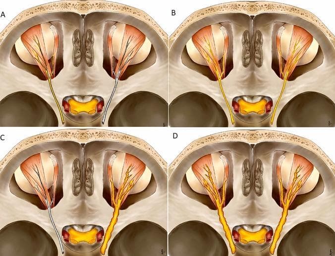 This medical illustration depicts four distinct patterns of cranial nerve enhancement (CNE) in an axial anatomical diagram of the skull base and orbits, focusing on the trigeminal and oculomotor regions. (A) Unilateral linear: Post-contrast enhancement (represented in yellow) along the course of a single nerve without an increase in its diameter. (B) Bilateral linear: Symmetrical enhancement of both nerves, maintaining a thin, smooth morphology. (C) Unilateral thickened: Pathological enhancement of one nerve accompanied by increased diameter and an irregular or nodular contour, contrasting with the normal contralateral nerve (white). (D) Bilateral thickened: Symmetrical enhancement and significant enlargement of both nerves with nodular irregularities. These patterns are used in neuroradiology to differentiate between various pathologies, such as viral neuritis (linear patterns) and neoplastic processes like perineural tumor spread or neurolymphomatosis (thickened patterns). The diagram serves as a diagnostic educational tool for classifying imaging findings in magnetic resonance imaging (MRI) and computed tomography (CT) of the cranial nerves.