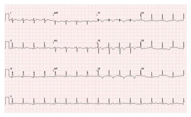 This diagnostic image is a 12-lead electrocardiogram (ECG) displaying a patient in normal sinus rhythm with a heart rate of approximately 110 beats per minute (sinus tachycardia). The tracing demonstrates a clear right axis deviation, characterized by a predominantly negative QRS complex in lead I and a positive QRS complex in leads II, III, and aVF. Notable repolarization abnormalities are present, specifically prominent T-wave inversions in lead III and across the precordial leads V1 through V4. The QRS complexes are relatively narrow with consistent morphology, and R-R intervals remain regular. These visual findings, including the right axis deviation and right-sided precordial T-wave inversions, are clinically significant as they often indicate right ventricular strain or pressure overload. In the provided clinical context of an atrial mass, these features suggest secondary cardiac hemodynamic changes. This ECG serves as an educational example of how systemic or structural heart disease, such as cardiac myxoma, can manifest with specific conduction and repolarization patterns on a surface electrocardiogram.