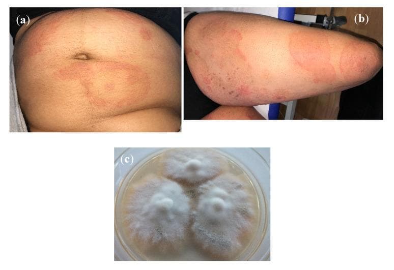 This composite figure provides a clinical and laboratory overview of a dermatophytosis infection caused by Trichophyton mentagrophytes Type VIII. Images (a) and (b) are clinical photographs displaying classic signs of tinea corporis. Photograph (a) shows the abdomen with multiple erythematous, annular (ring-shaped) lesions featuring raised, active red borders and central clearing. Photograph (b) depicts large, coalescing, arcuate plaques on the thigh with peripheral scaling and varying degrees of erythema. Image (c) is a diagnostic microbiology photograph showing a subculture of the isolate on Sabouraud's dextrose agar. The fungal colonies are fast-growing, characterized by a white, granular texture with flat, radiating margins. This visual set demonstrates the correlation between dermatological manifestations and mycological identification for an emerging anthropophilic fungal variant. The content is suitable for medical education regarding fungal skin infections, diagnostic dermatology, and medical mycology.