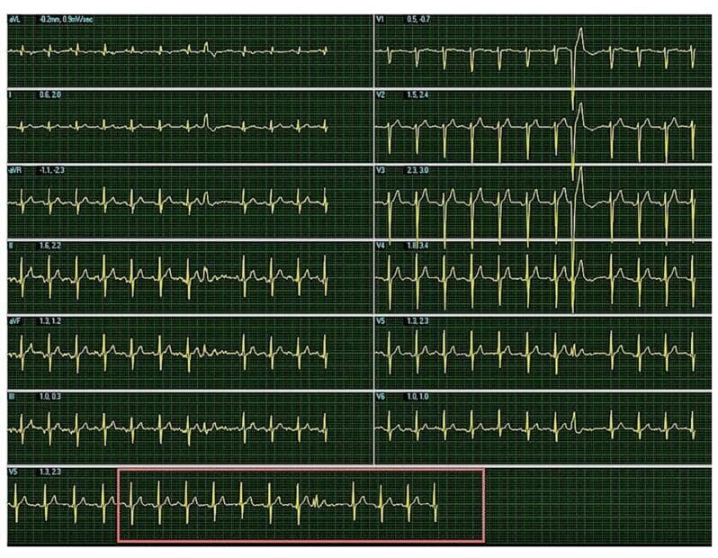 A 12-lead resting electrocardiogram (ECG) displayed on a digital grid background. The tracing shows a patient in sinus rhythm with a heart rate of 95 bpm and a QRS axis of approximately +70 degrees. Key findings include narrow QRS complexes in the majority of leads, with a transition characterized by an r/S pattern in the precordial leads V2 and V3, and an R/S relationship in the inferior leads II, III, and aVF. Notably, the tracing demonstrates a unifocal premature ventricular contraction (PVC). This ectopic beat exhibits a wide QRS duration, slurred morphology, and a left bundle branch block (LBBB) pattern, indicating an origin in the right ventricle. The image serves as an educational example of arrhythmia detection in the clinical context of post-COVID-19 myocardial assessment, highlighting the distinction between normal conduction and ventricular ectopy.