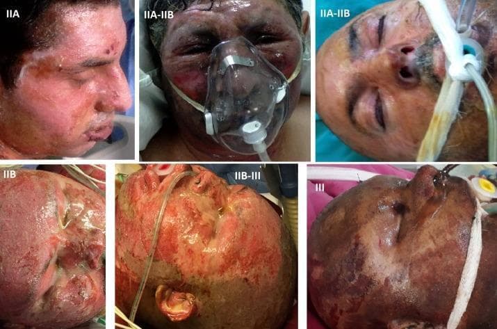 This composite of six clinical photographs illustrates the progression and varied morphology of facial burn injuries, categorized by depth and severity from Grade IIA to Grade III. Image IIA shows superficial partial-thickness burns with erythematous skin, moist texture, and minor blistering. Images IIA-IIB transition to deep partial-thickness burns, presenting with mottled red-and-white areas, significant facial edema, and periorbital swelling. Image IIB demonstrates more extensive dermal damage with less blanching. Images marked IIB-III and III showcase full-thickness burns, characterized by a leathery, charred appearance, necrotic eschar, and dark brown-to-black discoloration indicating complete destruction of the dermis and underlying appendages. The clinical context is reinforced by visible medical interventions, including oxygen masks, nasogastric tubes, and endotracheal tubes, highlighting the critical nature of airway management and supportive care in severe thermal trauma. This series serves as an educational tool for distinguishing burn depth based on color, exudate presence, and tissue texture in a clinical setting.