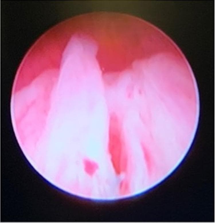 This cystoscopic image provides a procedural view of an undervirilized prostatic urethra in a patient with a Disorder of Sex Development (DSD). The primary anatomical focus is the urethral lumen, which appears underdeveloped and narrow. A prominent feature is the presence of a central tissue ridge or verumontanum-like structure. Adjacent to this, the opening to a large prostatic utricle or Mullerian remnant is visible as a dark, recessed cavity at the urethral apex. The surrounding mucosal tissue is characterized by a healthy pink-to-red color with smooth surfaces. This clinical photograph demonstrates the internal urogenital anatomy typical of complex ambiguous genitalia, specifically highlighting the confluence of a urogenital sinus and the persistence of Mullerian structures in a 46,XX individual with ovotesticular DSD.