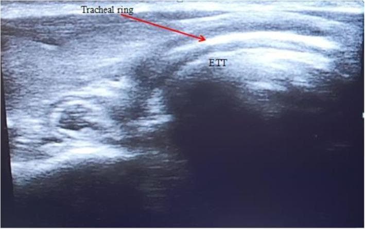 This diagnostic ultrasound image demonstrates a midline cross-sectional view of the adult trachea for the confirmation of endotracheal tube (ETT) placement. The image displays the anterior tracheal anatomy, characterized by a distinct, bright hyperechoic curved line representing the tracheal ring, indicated by a red arrow. Deep to this air-mucosal interface, a heterogeneous hypoechoic structure is visible within the tracheal lumen, labeled as 'ETT', representing the endotracheal tube in a correct intraluminal position. The visualization relies on the contrast in acoustic impedance between the echogenic tracheal wall and the relatively hypoechoic ETT. This ultrasound technique is used in emergency and anesthesiology contexts to verify airway management and rule out esophageal intubation, which would typically present as a 'double-track' or second air-mucosal interface lateral to the trachea. The image serves as an educational example of point-of-care ultrasound (POCUS) application in respiratory medicine and critical care.