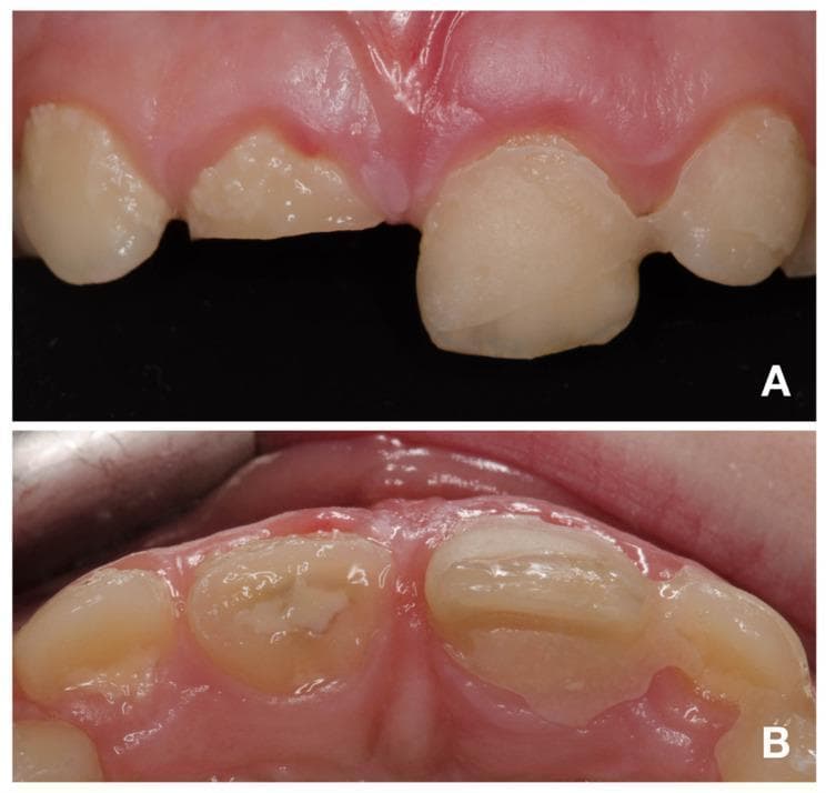 Two intraoral clinical photographs showing a traumatic dental injury in the maxillary anterior region (teeth 12–22). View A (buccal/labial) demonstrates a complicated crown-root fracture of the maxillary right central incisor (tooth 11). The fracture is oblique, extending apically from the labial toward the palatal surface. Stabilization is provided by a dental splint connecting tooth 21 to the adjacent primary canine (63). View B (occlusal) provides a superior perspective of the injury, highlighting the palatal margin of the fracture on tooth 11, located approximately 2 mm above the marginal gingiva. The image illustrates severe dental trauma, likely classified as Ellis Class III, involving the enamel, dentin, and pulp. The surrounding gingival tissue shows slight erythema consistent with recent trauma. This material is used in pediatric dentistry and endodontics to teach the visual assessment of crown-root fractures and the clinical application of emergency stabilization splints in mixed dentition.