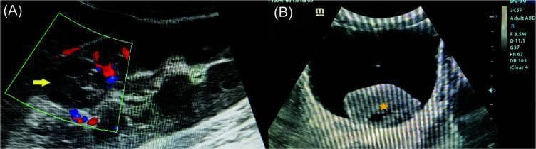 This dual-panel diagnostic image presents ultrasonographic findings of the urinary system in a case of renal oncocytoma. Image (A) is a Color Doppler ultrasonography of the right kidney showing a well-circumscribed, heteroechoic, cortical-based lesion (yellow arrow) in the upper pole. The Doppler overlay reveals no significant internal vascularity within the mass, a feature useful in differentiating renal lesions. Image (B) is a high-resolution transverse ultrasonography of the urinary bladder. It demonstrates a large, well-defined, heteroechoic mass (yellow star) settled in the dependent portion of the bladder lumen, characteristic of a giant retained blood clot secondary to gross hematuria. The clot shows mixed echogenicity with internal hypoechoic and hyperechoic regions, distinct from the anechoic urine and the uniform echogenicity of the bladder wall. These images illustrate the primary renal tumor and its downstream clinical complication of bladder clot retention, relevant for radiology and urology training.