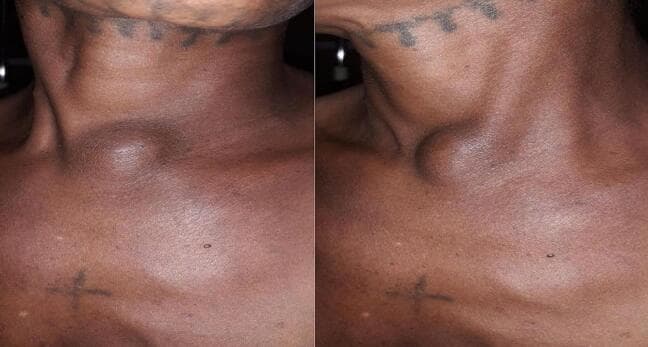 Clinical photograph (preoperative) showing the anterior neck and upper chest of a patient. The central focus is a prominent, well-defined, round cystic swelling located in the midline at the suprasternal notch. The mass is approximately 5-6 cm in diameter and protrudes significantly from the surrounding skin surface. The overlying skin appears intact without erythema or ulceration. This presentation is characteristic of a thyroglossal duct cyst or other congenital midline neck masses like dermoid cysts. Anatomical landmarks include the sternocleidomastoid muscles and the clavicular heads. Incidental findings include decorative tattoos on the submental region and the upper chest, along with a small melanocytic nevus on the left upper chest. The image demonstrates the typical clinical manifestation of a low-lying midline neck cyst, which is an important diagnostic consideration in pediatric and adult surgical pathology.