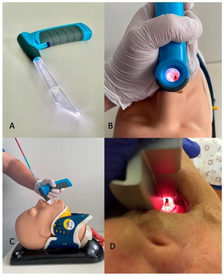 This composite educational image illustrates airway management techniques using the VieScope, a novel Miller-shaped (straight) laryngoscope, in comparison to conventional methods. Panel A displays the device, featuring a transparent acrylic glass tube blade that provides 360-degree circular LED illumination and a blue ergonomic handle with a textured grip. Panel B shows the device being used on a medical manikin, demonstrating the line-of-sight visualization through the lumen of the laryngoscope tube. Panel C illustrates the clinical technique for intubation with this device, where a bougie is first introduced through the VieScope to facilitate subsequent placement of an endotracheal tube; the manikin is shown with a cervical collar, simulating a trauma or difficult airway scenario. Panel D provides a contrast with a traditional Macintosh curved-blade laryngoscope, showing the visualization of the glottic opening during direct laryngoscopy. The content focuses on anesthesiology, emergency medicine, and advanced airway management education, highlighting the structural differences and procedural workflow between straight-tube and curved-blade laryngoscopy.