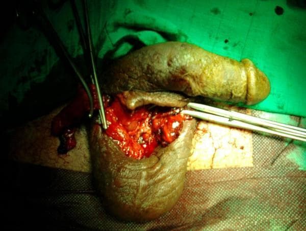 This clinical intraoperative photograph documents a surgical procedure in the male urogenital region, specifically focusing on the ligation of the spermatic cords following traumatic scrotal injury. The image shows an open scrotal wound with raw, erythematous tissue and visible hemorrhage. Two stainless steel surgical instruments are in use: a hemostatic clamp is seen grasping a dark red tubular structure, identified as the spermatic cord, to achieve hemostasis, while a second instrument (surgical probe or forceps) is positioned to manipulate the surrounding tissue. The penis and remaining scrotal skin are visible, showing significant ecchymosis and traumatic disruption. The procedure is being performed under sterile conditions, as indicated by the green surgical drapes. This visual demonstrates the surgical management of severe scrotal trauma and the anatomical localization required for ligating vascular and ductal structures in the perineal region.