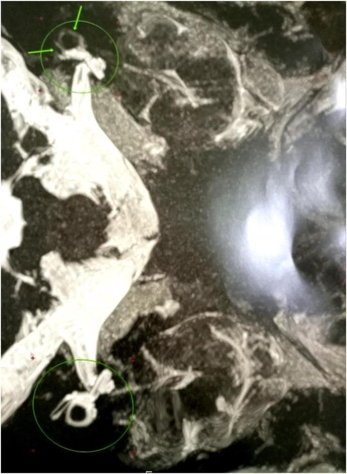 This diagnostic image is a high-resolution grayscale scan of the inner ear, likely a specialized MRI sequence focused on the temporal bone. It illustrates the anatomical structures of the vestibular system, specifically the semicircular canals. The image highlights pathological changes characterized by focal obliteration of the semicircular canal lumens. Instead of the typical smooth, continuous, and rounded contours of a healthy labyrinth, the affected canals exhibit a distinct 'spiky' appearance and irregular margins, as indicated by the green circles and arrows. These visual features are consistent with labyrinthitis ossificans, a process where the fluid-filled spaces of the inner ear are replaced by fibrous tissue or new bone formation following an inflammatory event. This finding is clinically significant for diagnosing causes of sensorineural hearing loss and vestibular dysfunction. The contrast between the bright signal of the remaining fluid-filled spaces and the dark, irregular areas of obliteration allows for the assessment of disease progression within the bony labyrinth.