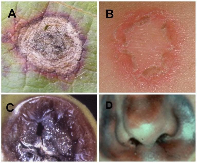 A comparison chart consisting of four panels (A-D) illustrating morphological similarities between plant and human fungal infections. Panel B shows a clinical photograph of dermatophytosis (ringworm) on human skin, characterized by a classic annular (ring-shaped) lesion with a raised, erythematous, and slightly scaly border and central clearing. Panel D presents a clinical photograph of invasive mucormycosis affecting the human nasal region, demonstrating extensive tissue necrosis with dark brown to black discoloration and ulceration around the nostrils and nasal bridge. For educational comparison, Panels A and C show botanical fungal infections: panel A depicts a Cercospora shot hole lesion on a leaf with necrotic centers and pigmented margins, while panel C shows Botrytis fruit rot with soft, dark, necrotic tissue and fungal spores. This visual resource is designed for medical students and dermatologists to understand fungal pathogenesis and the cross-kingdom similarities in host tissue responses such as necrosis and inflammation.