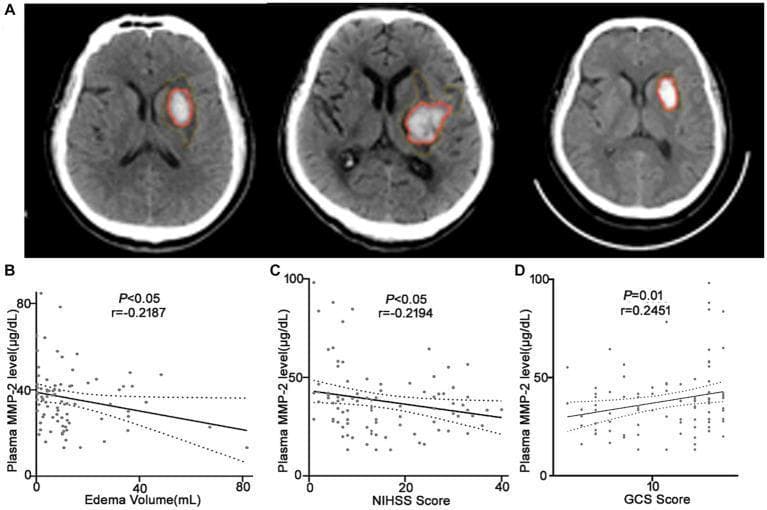 This composite image illustrates the correlation between plasma Matrix Metalloproteinase-2 (MMP-2) levels and clinical parameters in patients with intracerebral hemorrhage (ICH). Panel A presents three non-contrast axial CT brain scans demonstrating acute hypertensive ICH in the basal ganglia. Each scan features manual segmentations: red outlines highlight the hyperdense hematoma, while yellow outlines demarcate the surrounding hypodense perihematomal edema (PHE). Panels B, C, and D are scatter plots with linear regression lines and 95% confidence intervals showing bivariate correlation analysis (Spearman coefficient). Graph B shows a statistically significant negative correlation (r = -0.2187, p < 0.05) between plasma MMP-2 levels (µg/dL) and edema volume (mL). Graph C indicates a negative correlation (r = -0.2194, p < 0.05) with the NIH Stroke Scale (NIHSS) score, representing neurological deficit severity. Graph D displays a positive correlation (r = 0.2451, p = 0.01) between MMP-2 and Glasgow Coma Scale (GCS) scores, suggesting that higher MMP-2 levels are associated with better conscious states. The data collectively suggest that lower circulating MMP-2 levels correlate with increased brain edema and poorer clinical neurological status in ICH patients.